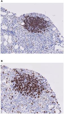 Lymphoid aggregates in the bone marrow biopsies of patients with myelodysplastic syndromes – A potential prognostic marker?